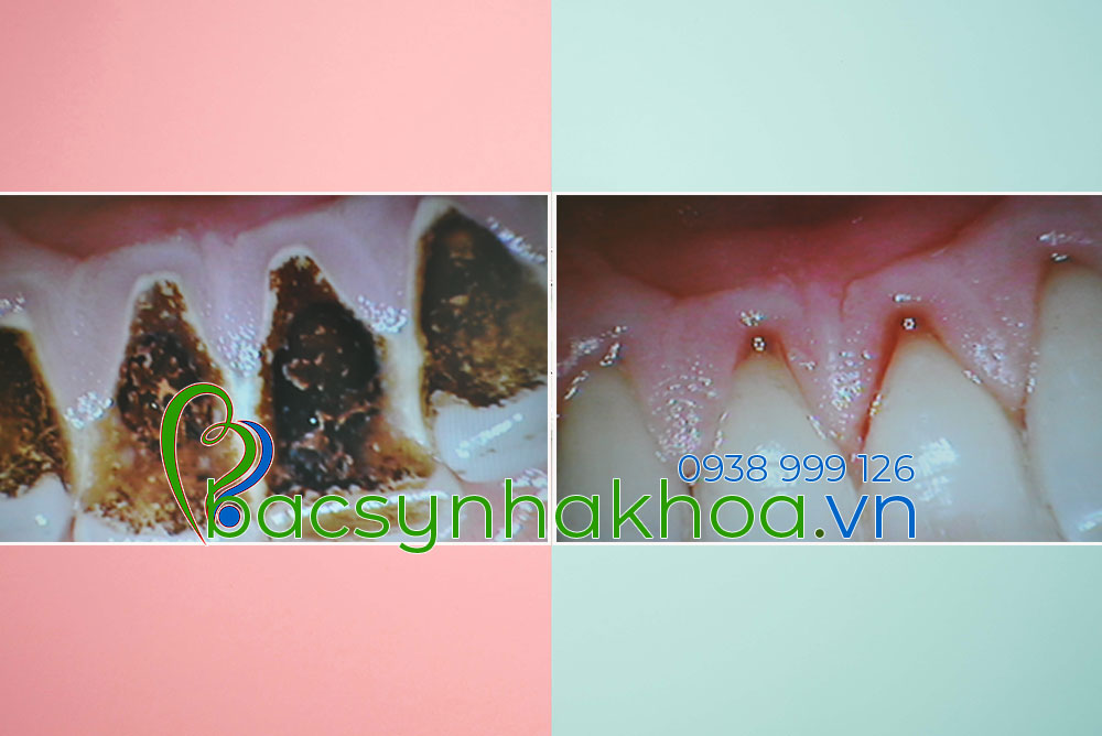 http://bacsynhakhoa.vn/img/bacsynhakhoa-mang-bam-thuoc-la-tren-rang.jpg