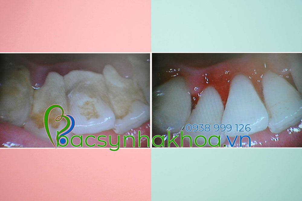 http://bacsynhakhoa.vn/img/bacsynhakhoa-voi-rang-hinh-thanh-nhu-the-nao.jpg
