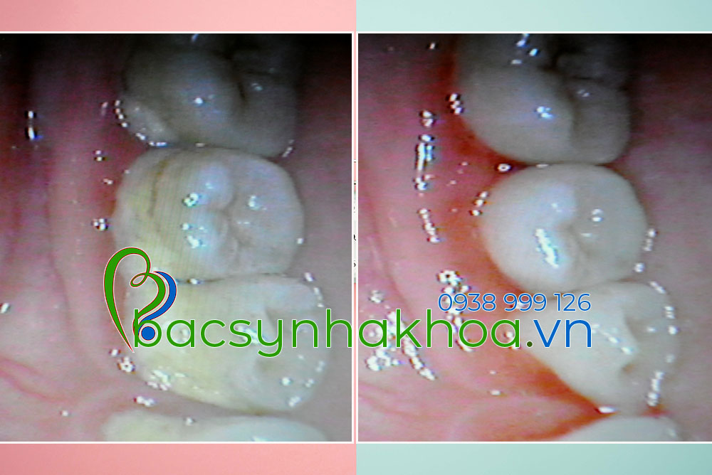 http://bacsynhakhoa.vn/img/bacsynhakhoa-voi-rang-la-gi.jpg