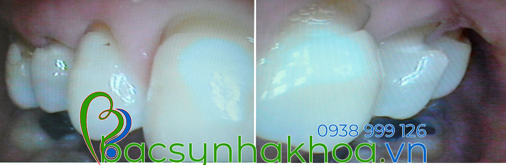 http://bacsynhakhoa.vn/img/bacsynhakhoavn-chan-rang-bi-khuyet.jpg