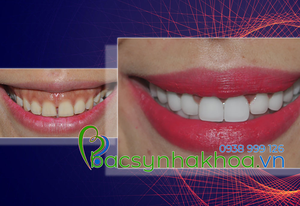 http://bacsynhakhoa.vn/img/bacsynhakhoavn-dieu-tri-nu-cuoi-thay-loi-gummy-smile-Giau.jpg