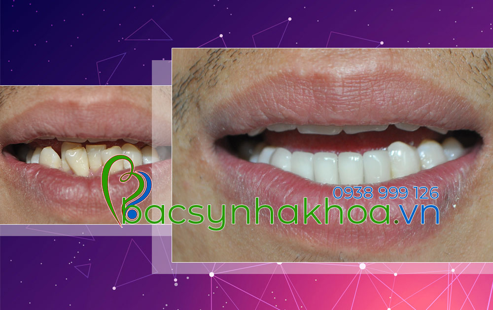 http://bacsynhakhoa.vn/img/bacsynhakhoavn-dieu-tri-rang-cua-lech-tham-my-Hai.jpg