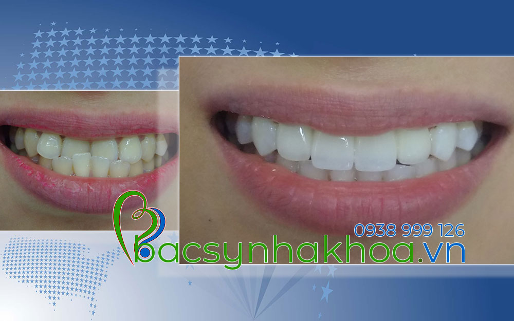 http://bacsynhakhoa.vn/img/bacsynhakhoavn-hai-rang-cua-bi-thut-vo-trong-Tuyen.jpg