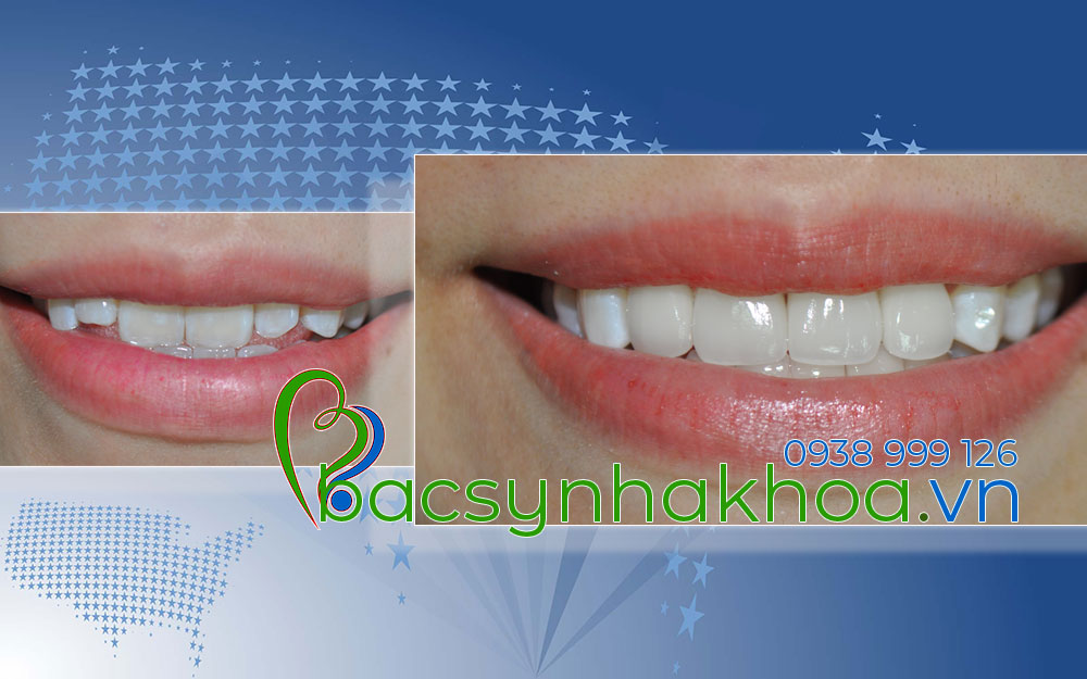 http://bacsynhakhoa.vn/img/bacsynhakhoavn-khop-can-nguoc-lam-rang-su-Trang-TVHK.jpg