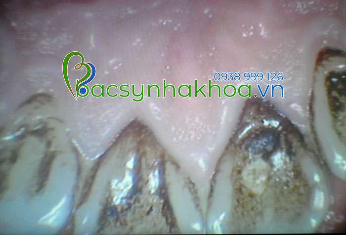 http://bacsynhakhoa.vn/img/bacsynhakhoavn-nguyen-nhan-gay-hoi-mieng.jpg