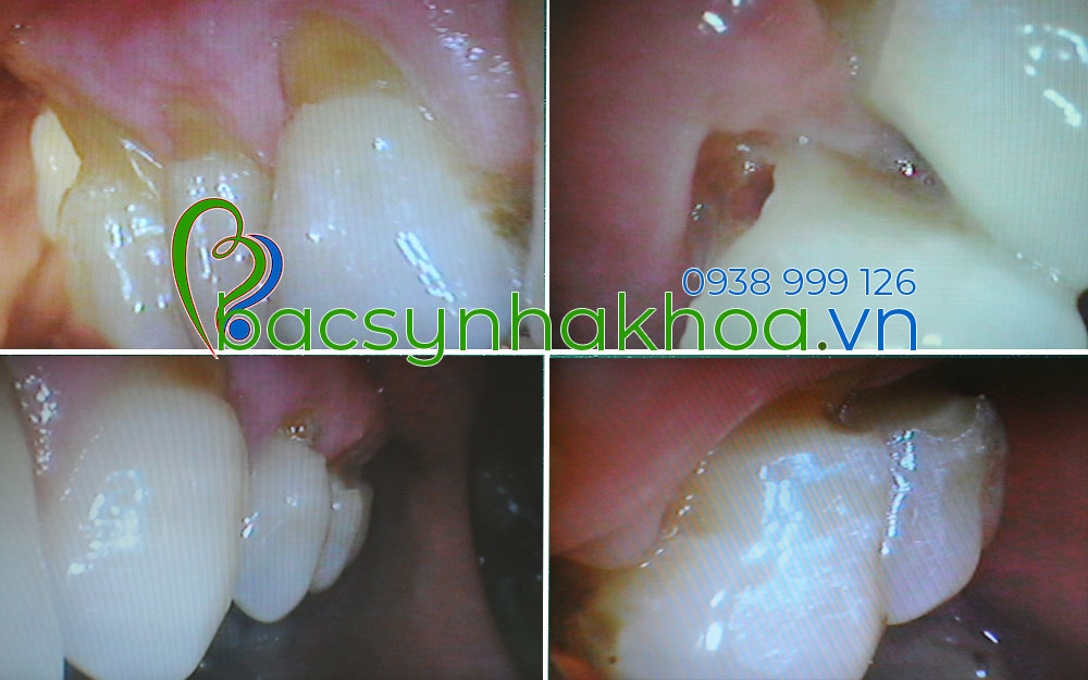 http://bacsynhakhoa.vn/img/bacsynhakhoavn-rang-bi-mon-phia-chan.jpg