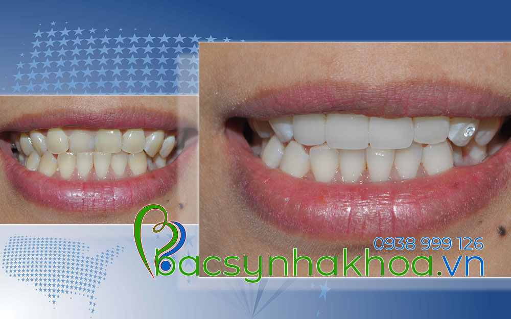 http://bacsynhakhoa.vn/img/bacsynhakhoavn-rang-cua-bi-mom-Bao-Khuyen.jpg