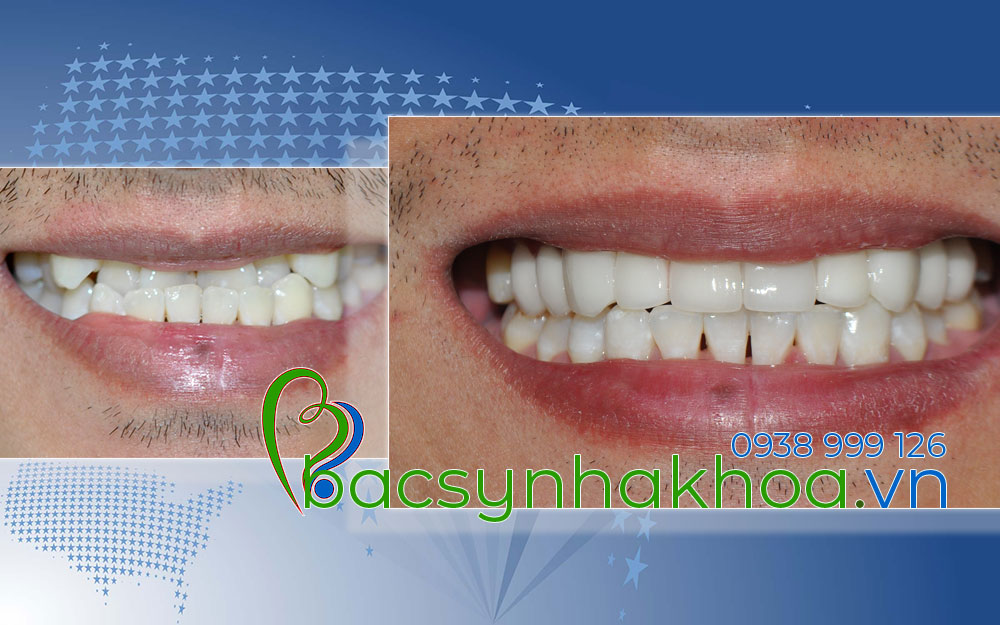 http://bacsynhakhoa.vn/img/bacsynhakhoavn-rang-cua-bi-mom-phai-lam-sao-cho-dep-Minh.jpg