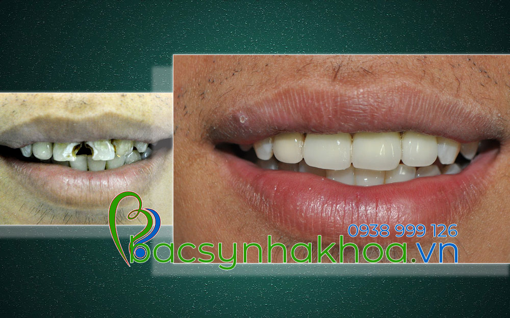 http://bacsynhakhoa.vn/img/bacsynhakhoavn-rang-cua-bi-sau-Hao.jpg