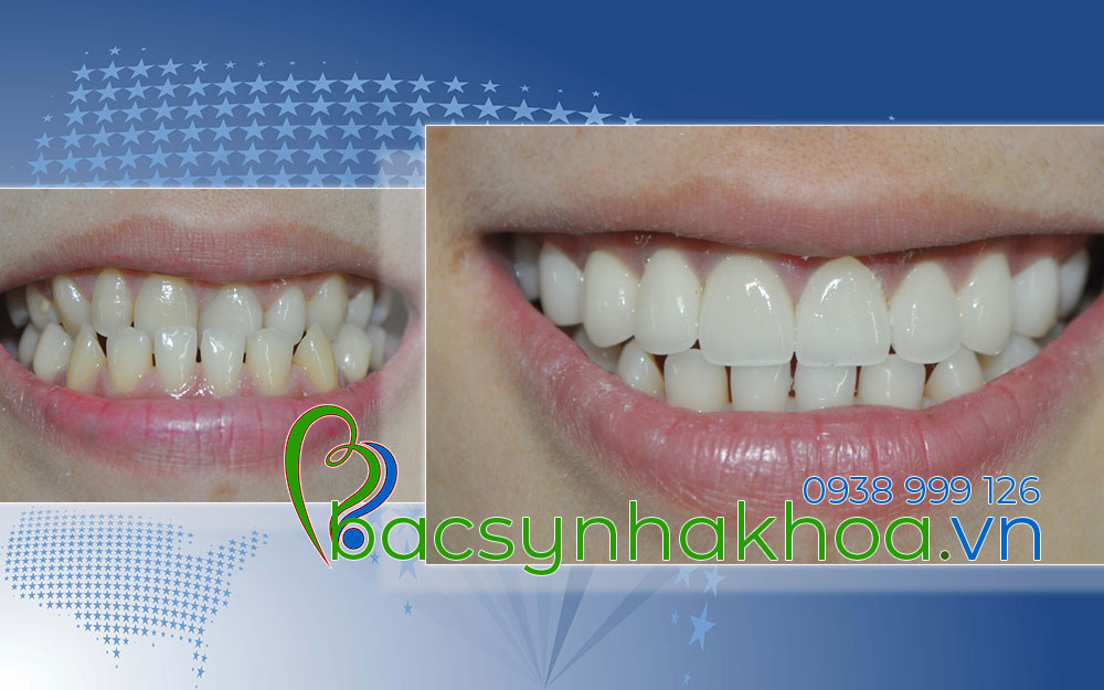 http://bacsynhakhoa.vn/img/bacsynhakhoavn-rang-mom-lam-tham-my-Truc.jpg