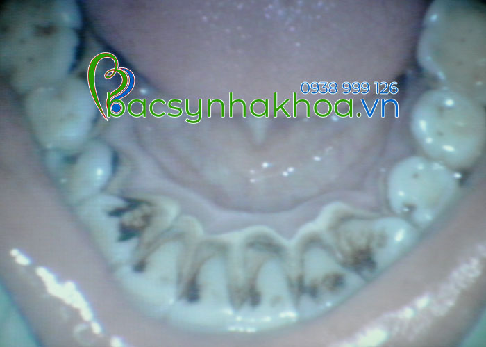 http://bacsynhakhoa.vn/img/bacsynhakhoavn-tac-hai-cua-thuoc-la-voi-rang-mieng.jpg