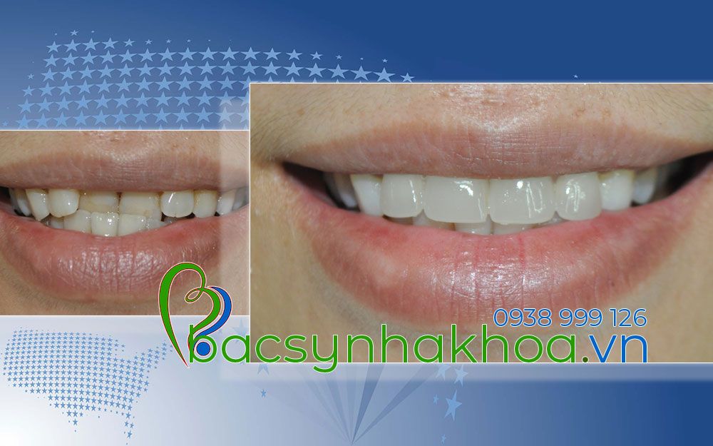 http://bacsynhakhoa.vn/img/bacsynhakhoavn-tham-my-cho-rang-bi-mom-Quyen.jpg