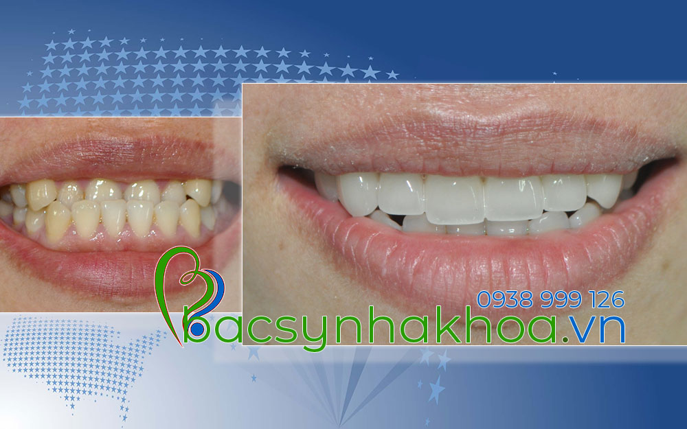http://bacsynhakhoa.vn/img/bacsynhakhoavn-tham-my-cho-rang-mom-Lanh.jpg