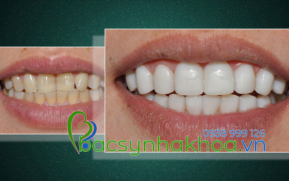 http://bacsynhakhoa.vn/img/bacsynhakhoavn-veneer-composite-cho-rang-bi-vang.jpg