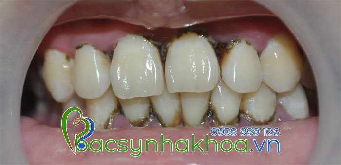 http://bacsynhakhoa.vn/img/bacsynhakhoavn-voi-rang-gay-viem-nuou-hoi-mieng.jpg