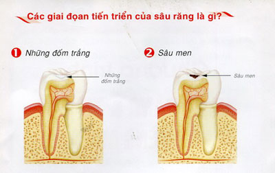 http://bacsynhakhoa.vn/img/nha-khoa-dien-bien-sau-rang-01.jpg