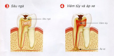 http://bacsynhakhoa.vn/img/nha-khoa-dien-bien-sau-rang-02.jpg