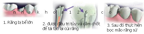 http://bacsynhakhoa.vn/img/nha-khoa-rang-bi-be-lon-duoc-cam-chot.jpg