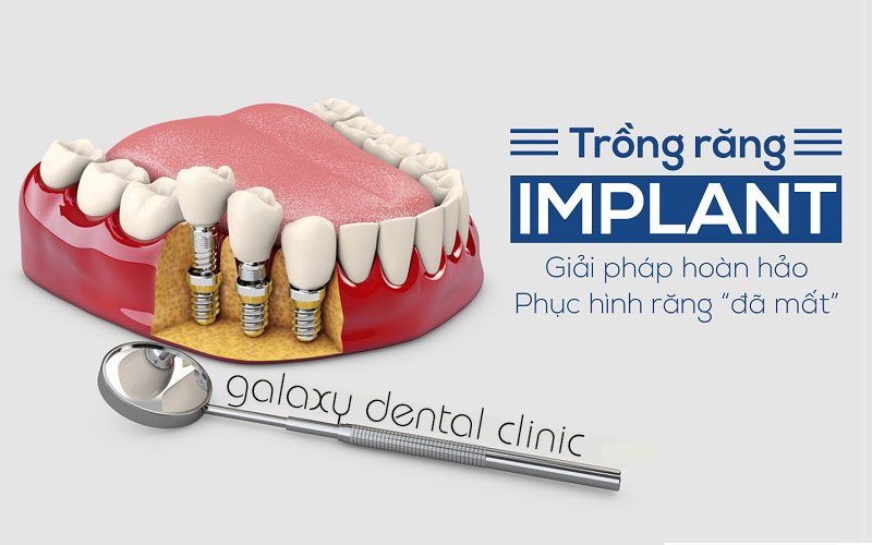 https://bacsynhakhoa.vn/img/galaxy-dental-Cay-ghep-implant-co-bien-chung-khong.jpg