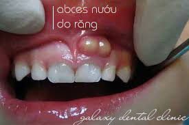 https://bacsynhakhoa.vn/img/galaxy-dental-abces-nuou-do-rang.jpg