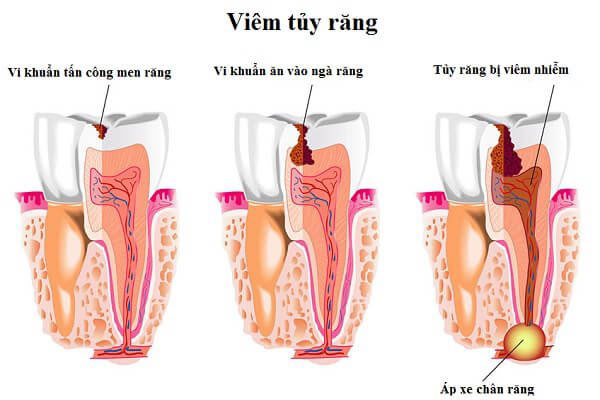 https://bacsynhakhoa.vn/img/galaxy-dental-benh-ly-tuy-rang.jpg