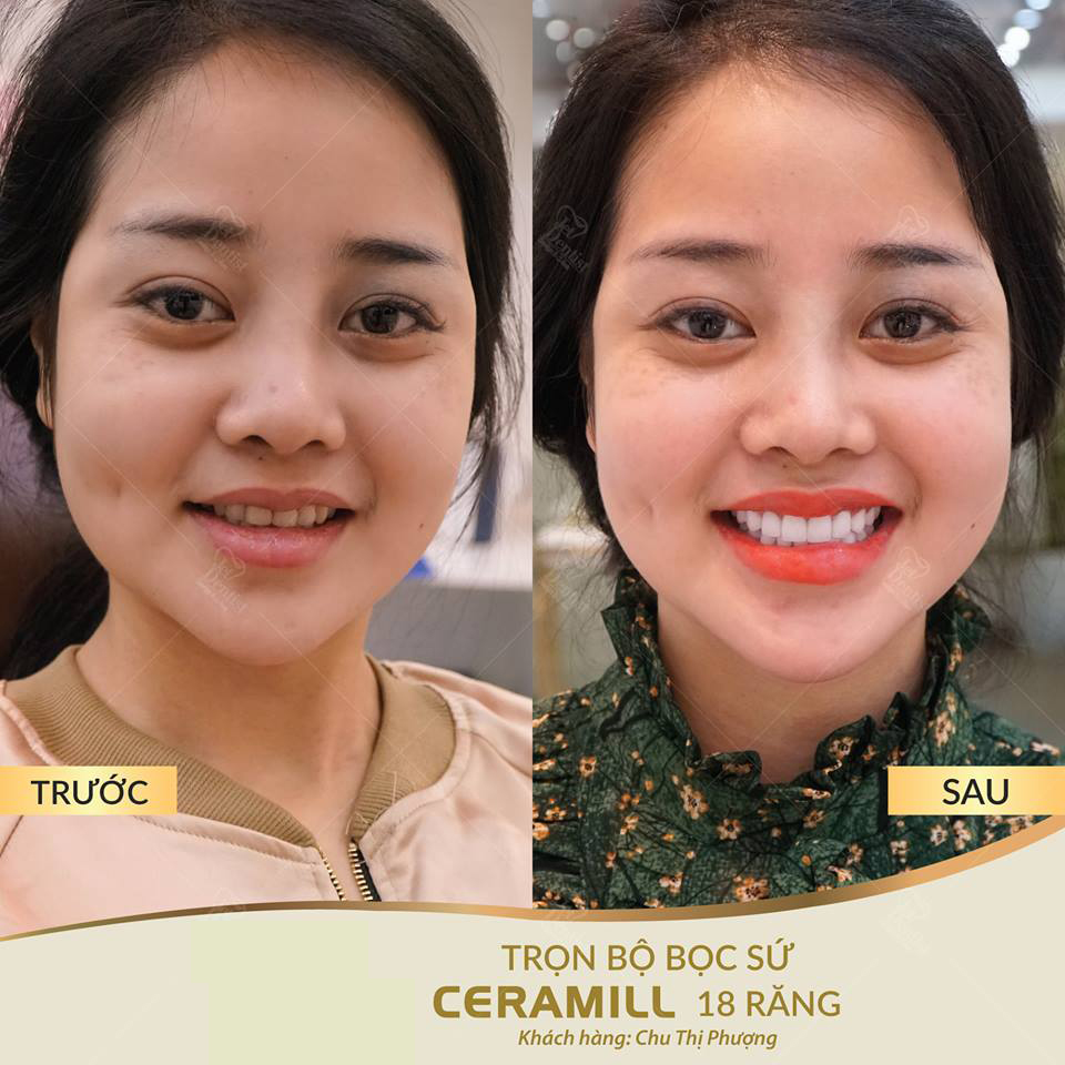 https://bacsynhakhoa.vn/img/galaxy-dental-boc-16-rang-su-zolid.jpg