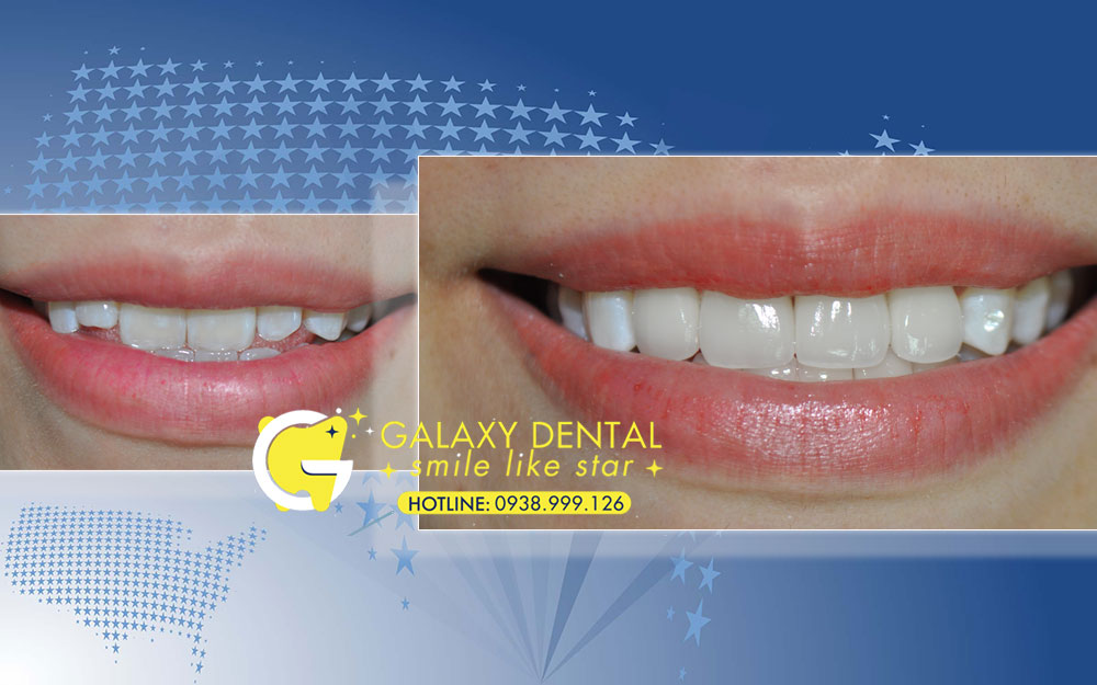 https://bacsynhakhoa.vn/img/galaxy-dental-boc-rang-su-tham-my-Trang.jpg