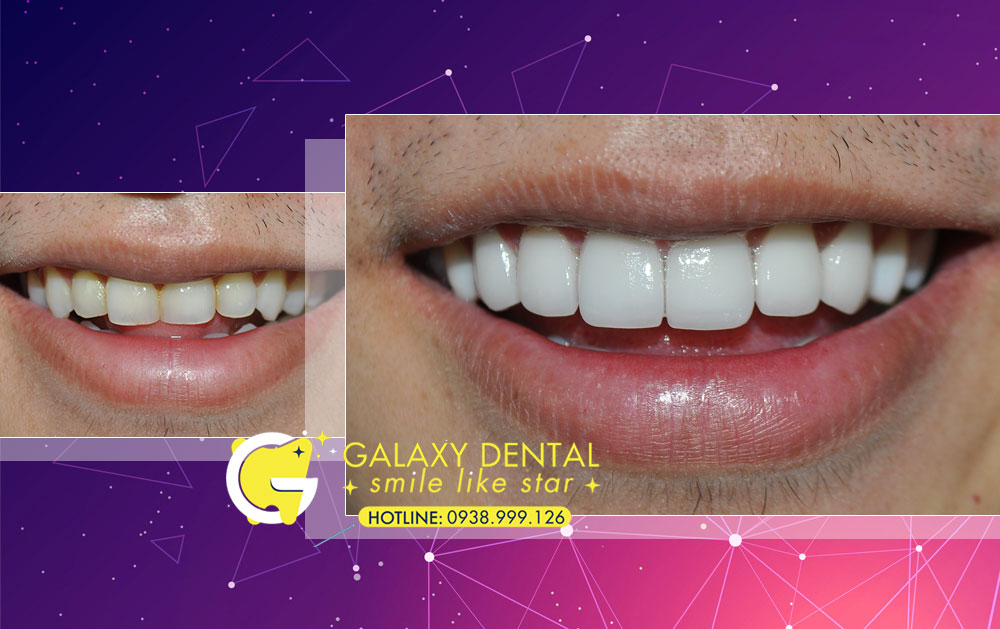 https://bacsynhakhoa.vn/img/galaxy-dental-boc-rang-su-tham-my-rang-su-zirconia-Quy.jpg