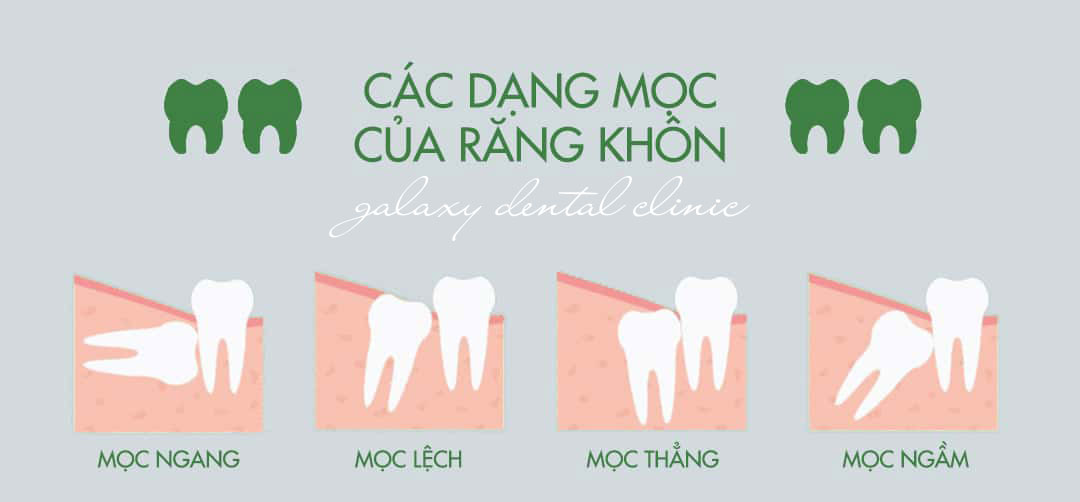 https://bacsynhakhoa.vn/img/galaxy-dental-cac-dang-moc-cua-rang-khon.jpg