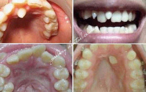 https://bacsynhakhoa.vn/img/galaxy-dental-cac-dang-rang-du.jpg