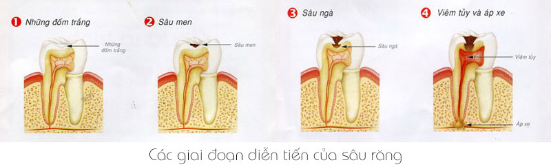 https://bacsynhakhoa.vn/img/galaxy-dental-cac-giai-doan-dien-tien-cua-sau-rang.jpg