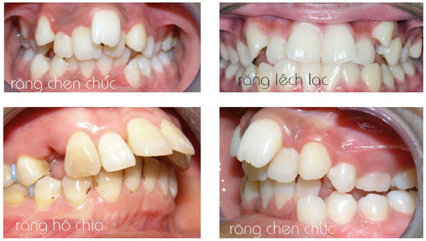 https://bacsynhakhoa.vn/img/galaxy-dental-cac-truong-hop-rang-lech-lac-khap-khenh-chen-chuc.jpg