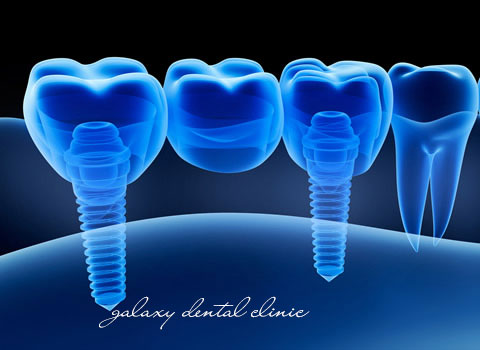 https://bacsynhakhoa.vn/img/galaxy-dental-cam-implant-co-dau-khong.jpg