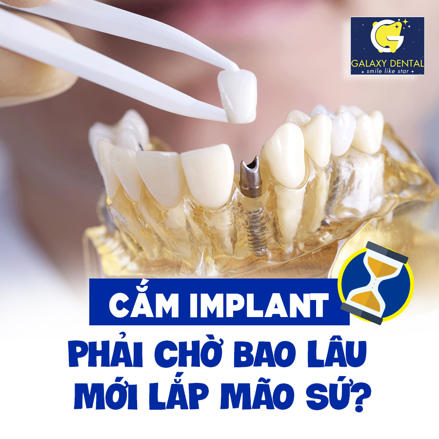 https://bacsynhakhoa.vn/img/galaxy-dental-cam-implant-sau-bao-lau-thi-trong-rang-su.jpg