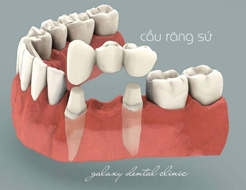 https://bacsynhakhoa.vn/img/galaxy-dental-cau-rang-su-co-dinh.jpg