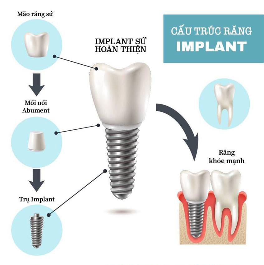 https://bacsynhakhoa.vn/img/galaxy-dental-cau-truc-implant-02.jpg