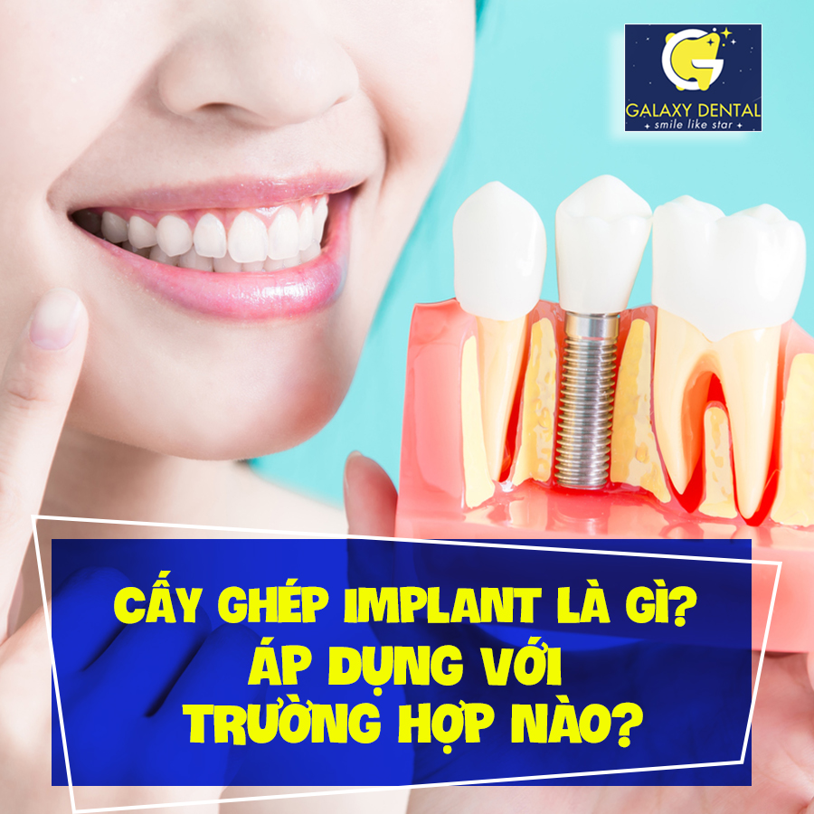 https://bacsynhakhoa.vn/img/galaxy-dental-cay-ghep-implant-la-gi.jpg