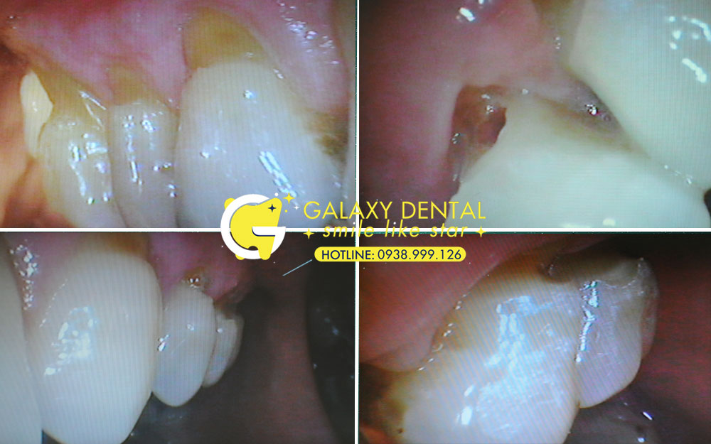 https://bacsynhakhoa.vn/img/galaxy-dental-chan-rang-bi-mon-rang-bi-e-buot-khi-uong-nuoc-lanh.jpg