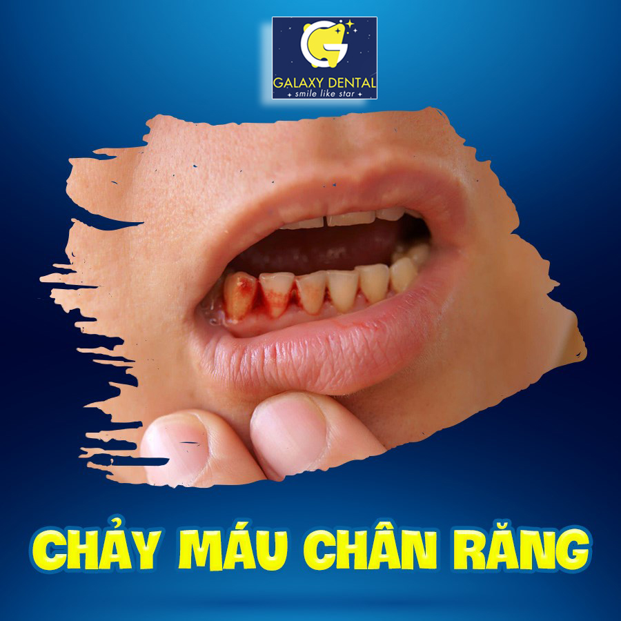 https://bacsynhakhoa.vn/img/galaxy-dental-chay-mau-nuou-rang.jpg