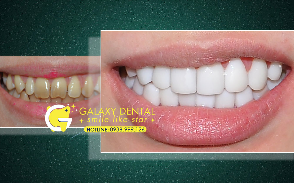 https://bacsynhakhoa.vn/img/galaxy-dental-chi-phi-cho-tram-dap-mat-men-rang.jpg