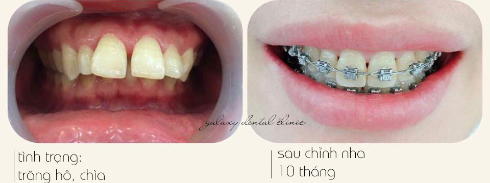 https://bacsynhakhoa.vn/img/galaxy-dental-chinh-nha-cho-rang-ho02.jpg