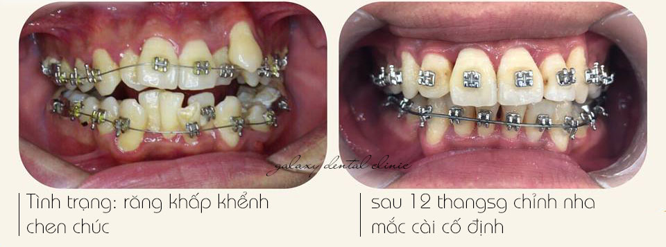 https://bacsynhakhoa.vn/img/galaxy-dental-chinh-nha-cho-rang-khap-khenh.jpg