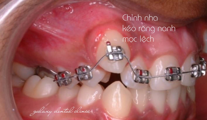 https://bacsynhakhoa.vn/img/galaxy-dental-chinh-nha-keo-rang-nanh-moc-ngam.jpg