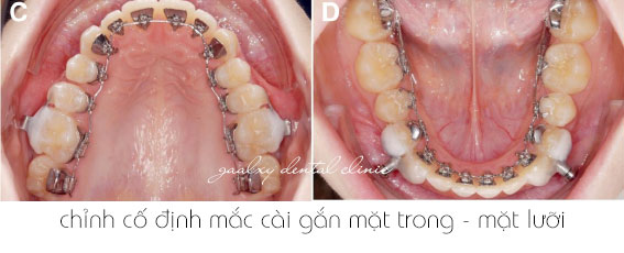 https://bacsynhakhoa.vn/img/galaxy-dental-chinh-nha-mac-cai-co-dinh-mat-trong.jpg