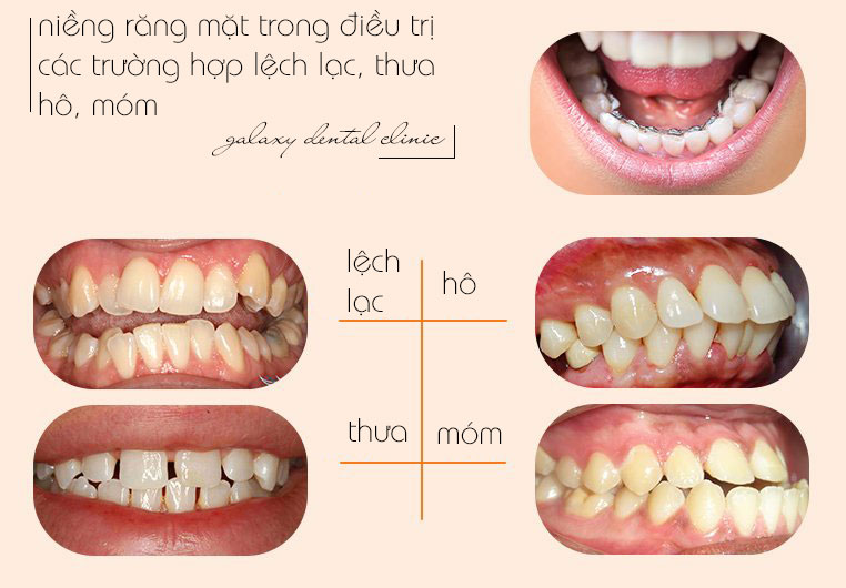 https://bacsynhakhoa.vn/img/galaxy-dental-chinh-nha-mat-trong-dieu-tri-cac-truong-hop-ho-mom-lech-lac.jpg