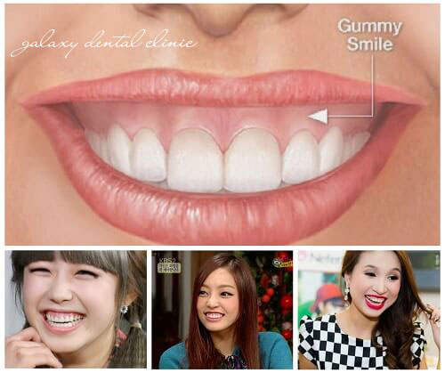 https://bacsynhakhoa.vn/img/galaxy-dental-chua-cuoi-ho-loi-nhu-the-nao.jpg