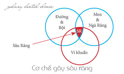 https://bacsynhakhoa.vn/img/galaxy-dental-co-che-gay-sau-rang.jpg