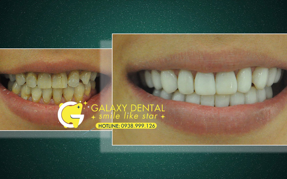 https://bacsynhakhoa.vn/img/galaxy-dental-dap-mat-men-rang-co-dau-khong-co-lau-khong.jpg