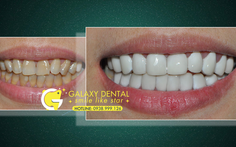 https://bacsynhakhoa.vn/img/galaxy-dental-dap-mat-men-rang-co-dau-khong.jpg