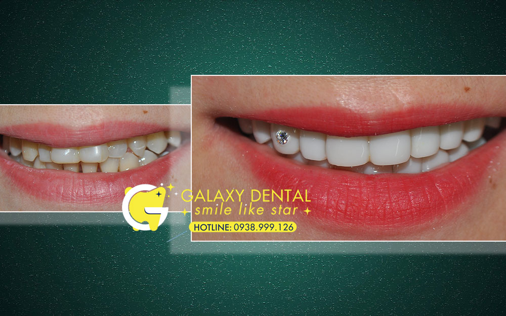 https://bacsynhakhoa.vn/img/galaxy-dental-dap-mat-men-rang-thay-ao-moi-cho-rang-Nga-maekup.jpg